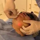 @cosmeto_laser_alice