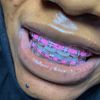 fashionbracesinilorin