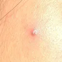 @pimplepoopings