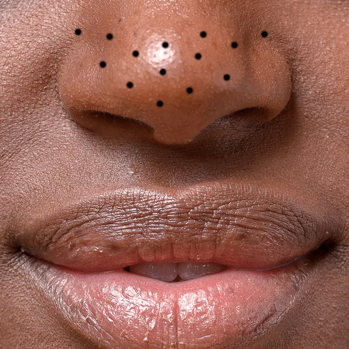 the_pimples