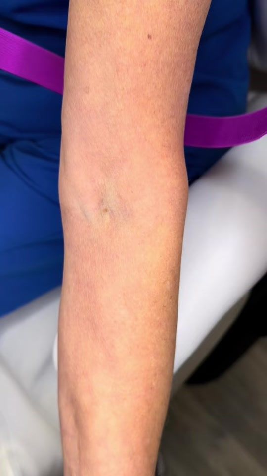 TikTok video thumbnail by jtmedical_aesthetics