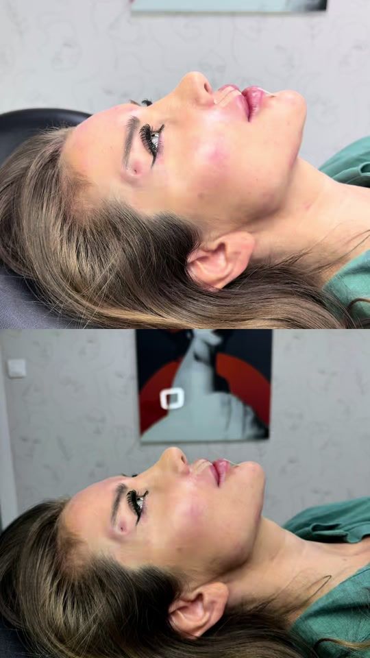 TikTok video thumbnail by dr.youssef_majed