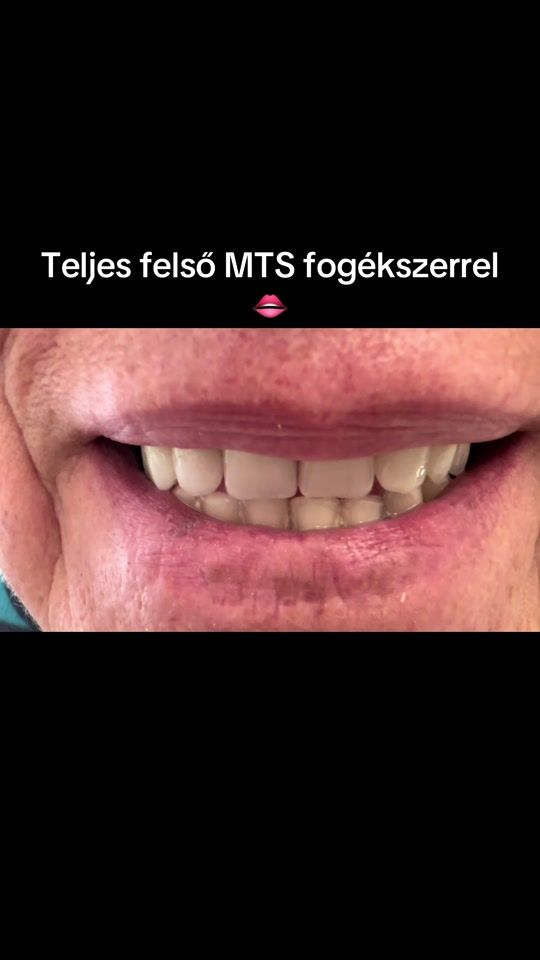 TikTok video thumbnail by mentadentfogaszat