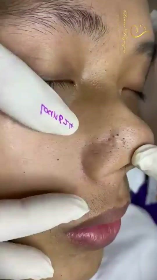 TikTok video thumbnail by pimple.satisfy