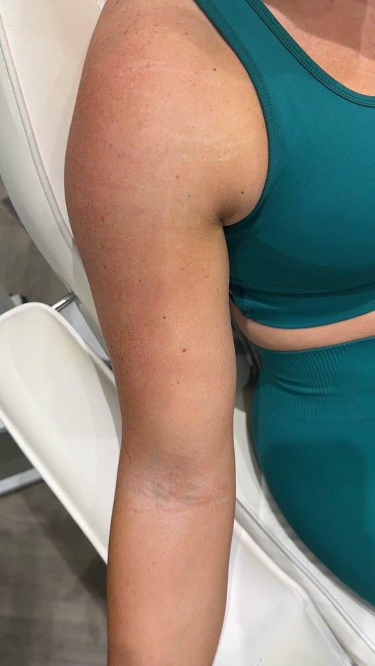 TikTok video thumbnail by jtmedical_aesthetics