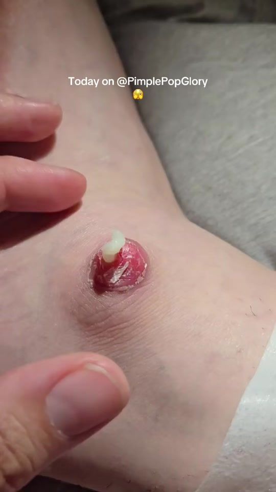 TikTok video thumbnail by pimplepopglory