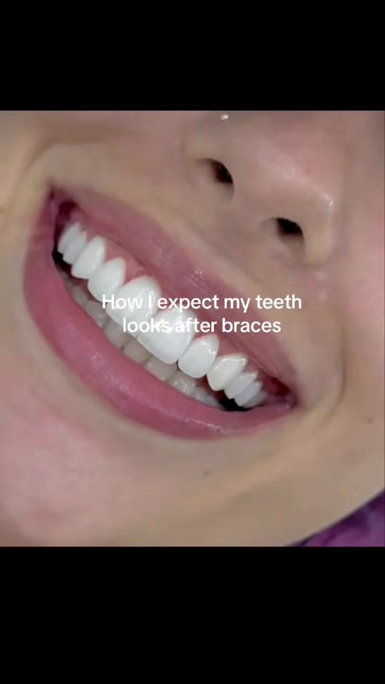 TikTok video thumbnail by get_braces