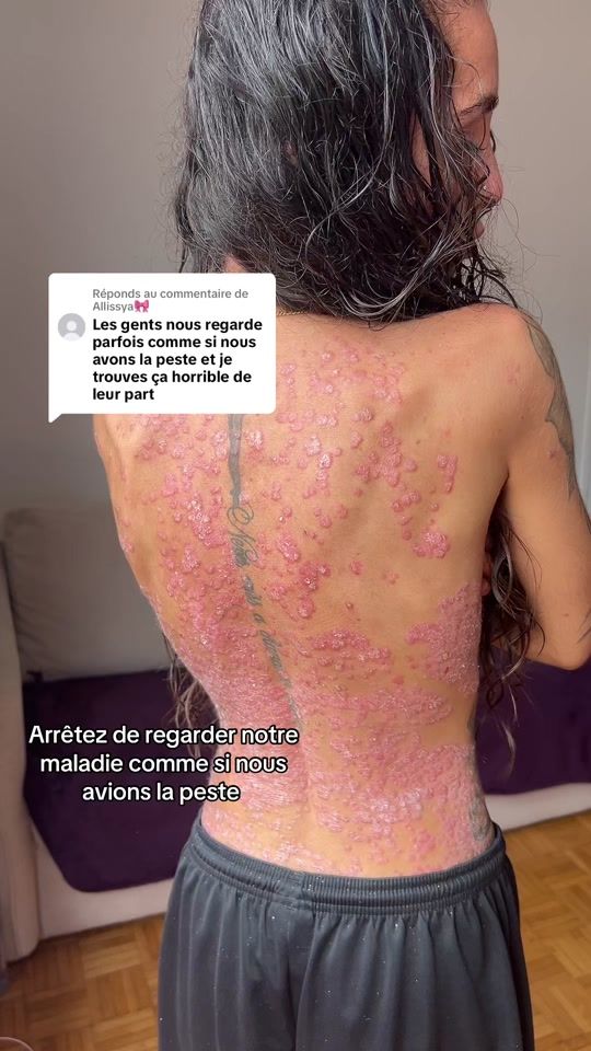 TikTok video thumbnail by lyla_psoriasistyle