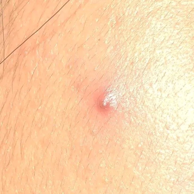 pimplepoopings