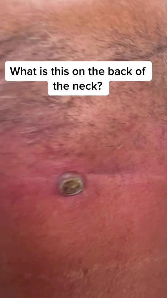 TikTok video thumbnail by drspf