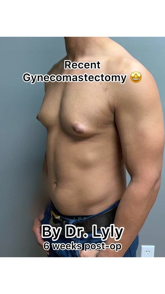 TikTok video thumbnail by vadoplasticsurgery