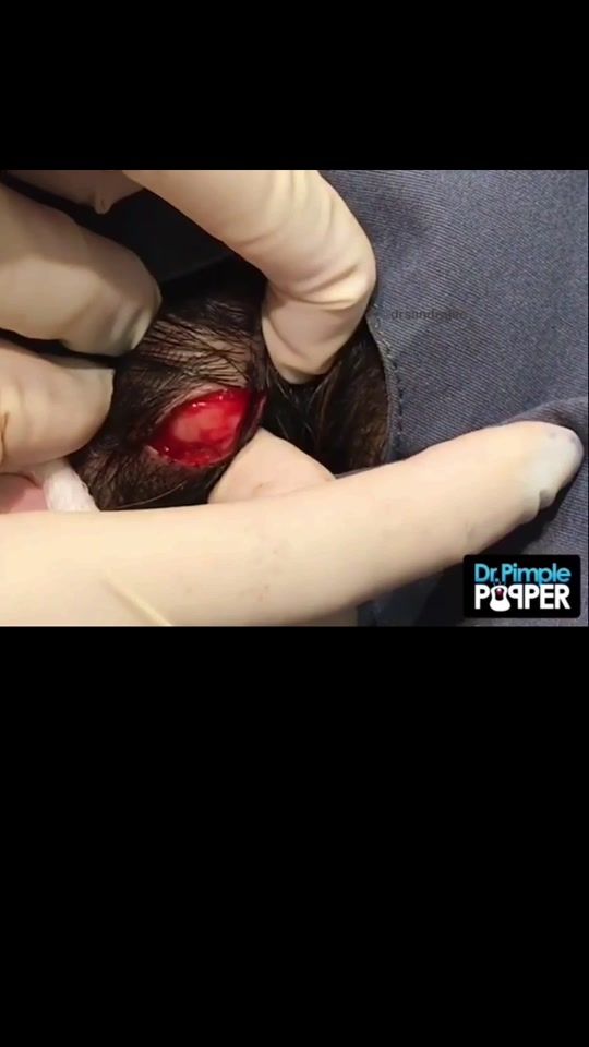 TikTok video thumbnail by drpimplepopper
