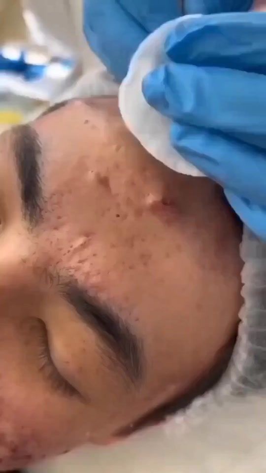 TikTok video thumbnail by acne_videos