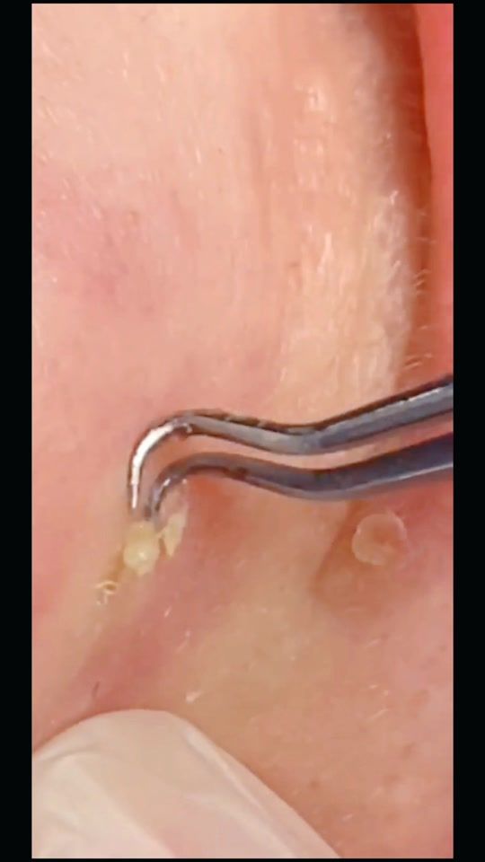 TikTok video thumbnail by pimple_2022
