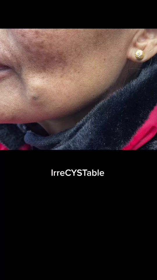 TikTok video thumbnail by drpimplepopper
