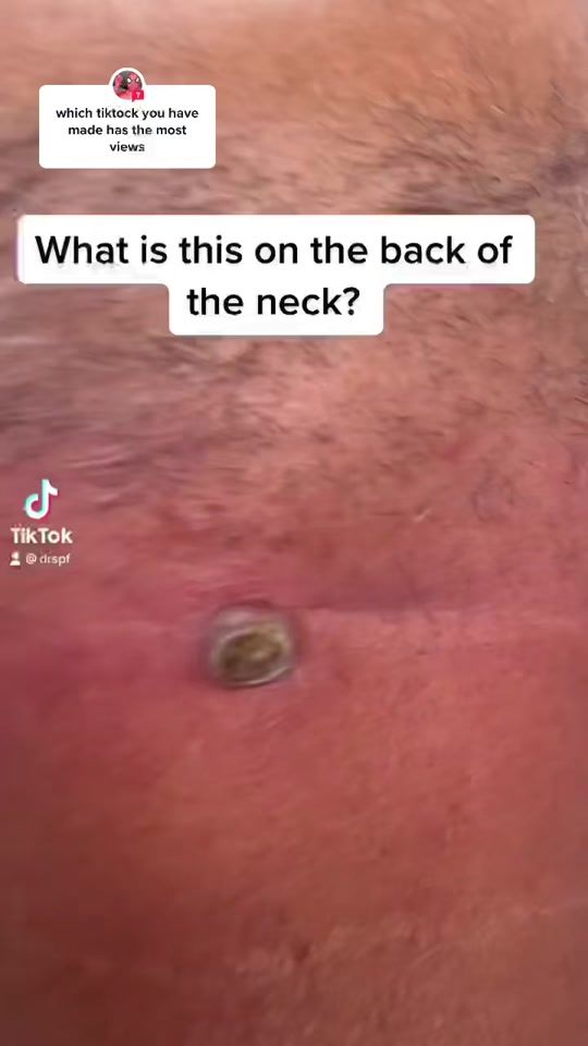 TikTok video thumbnail by drspf
