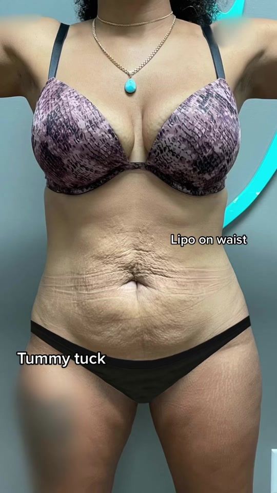 TikTok video thumbnail by vadoplasticsurgery
