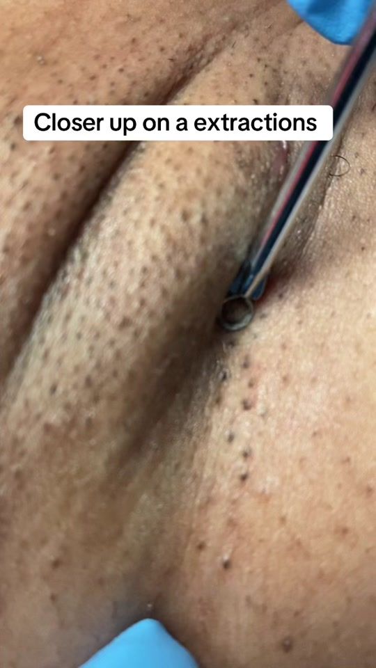 TikTok video thumbnail by lovebeyondskin0