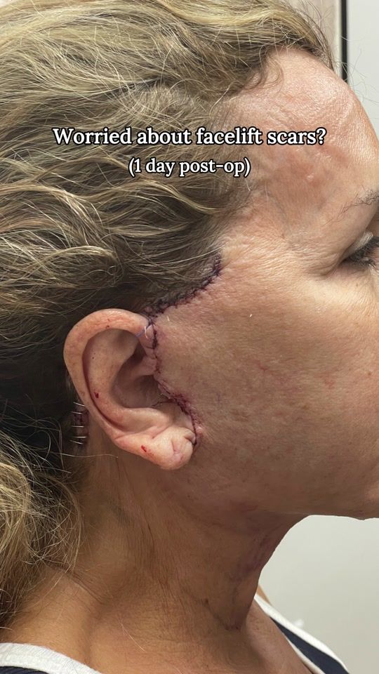 TikTok video thumbnail by vadoplasticsurgery